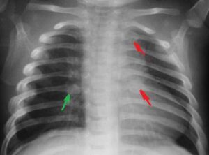 https://commons.wikimedia.org/wiki/File:Fractured_ribs.jpg Attribution: By National Institute of Health (National Institute of Health) [Public domain or Public domain], via Wikimedia Commons